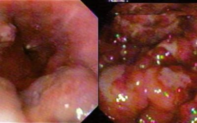 Esophageal Gastroduodenal Cryptococcosis: A Case Report